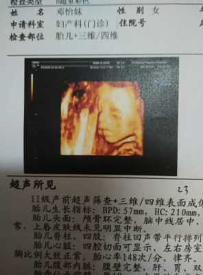 胎儿上唇厚(胎儿上唇皮肤) 第3张 胎儿上唇厚(胎儿上唇皮肤) 第3张