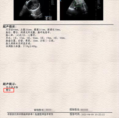 足月胎儿b超(足月胎儿b超数据) 第2张 足月胎儿b超(足月胎儿b超数据) 第2张