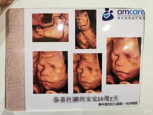 孕妇做四维彩超24周胎儿显示没有胆囊,24周胎儿胆囊偏小怎么回事  第2张