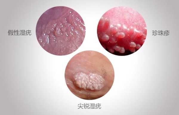 假性湿疣是什么病,孕期假性尖锐疣很痒怎么办 第1张 假性湿疣是什么病,孕期假性尖锐疣很痒怎么办 第1张
