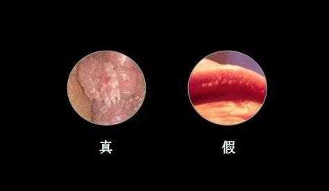 假性湿疣是什么病,孕期假性尖锐疣很痒怎么办 第2张 假性湿疣是什么病,孕期假性尖锐疣很痒怎么办 第2张