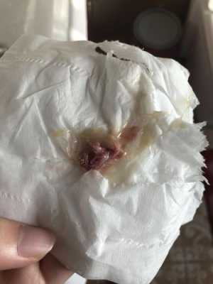 孕妇鼻屎多怎么回事,孕期鼻屎多怎么回事,而且还有血丝 第1张 孕妇鼻屎多怎么回事,孕期鼻屎多怎么回事,而且还有血丝 第1张