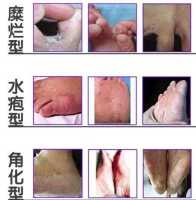 孕期足藓(孕期足藓怎么治疗) 第2张 孕期足藓(孕期足藓怎么治疗) 第2张