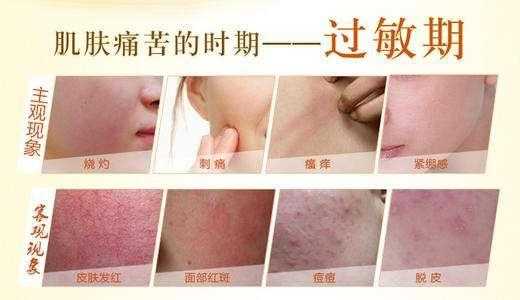 怀孕皮肤过敏庠怎么办,早孕期过敏怎么治疗 第2张 怀孕皮肤过敏庠怎么办,早孕期过敏怎么治疗 第2张