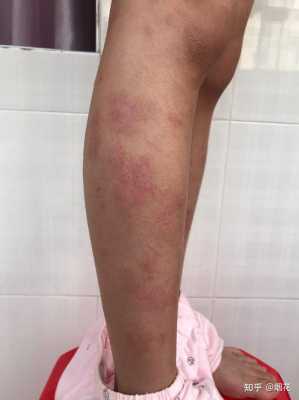 孕妇得了皮炎怎么办,能用药吗,孕妇皮炎影响胎儿吗知乎 第1张 孕妇得了皮炎怎么办,能用药吗,孕妇皮炎影响胎儿吗知乎 第1张