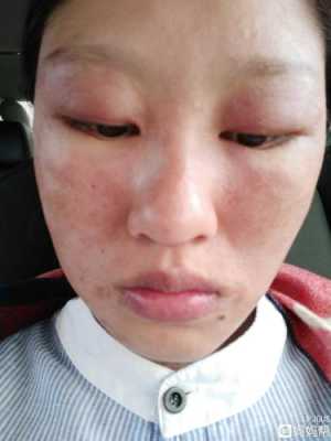孕妇得了皮炎怎么办,能用药吗,孕妇皮炎影响胎儿吗知乎 第2张 孕妇得了皮炎怎么办,能用药吗,孕妇皮炎影响胎儿吗知乎 第2张