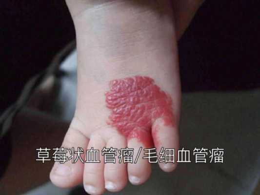胎儿怎样预防血管瘤(宝宝出生时有血管瘤是什么原因) 第3张 胎儿怎样预防血管瘤(宝宝出生时有血管瘤是什么原因) 第3张