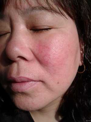 孕妇得皮炎影响胎儿吗(孕妇得皮炎影响胎儿吗) 第2张 孕妇得皮炎影响胎儿吗(孕妇得皮炎影响胎儿吗) 第2张
