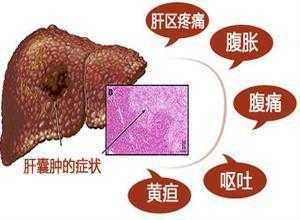 肝囊肿是怎么形成的,胎儿囊肿是什么原因引起的 第1张 肝囊肿是怎么形成的,胎儿囊肿是什么原因引起的 第1张