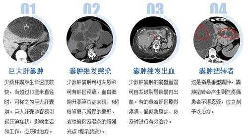 肝囊肿是怎么形成的,胎儿囊肿是什么原因引起的 第2张 肝囊肿是怎么形成的,胎儿囊肿是什么原因引起的 第2张