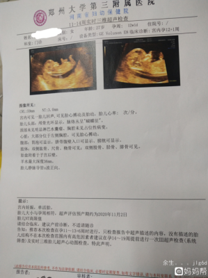 孕期没做nt（孕期没做nt检查怎么办）  第2张