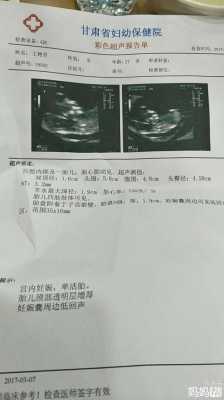 胎儿颈部透明多少钱(胎儿颈后透明层厚度的正常值是是多少) 第2张 胎儿颈部透明多少钱(胎儿颈后透明层厚度的正常值是是多少) 第2张