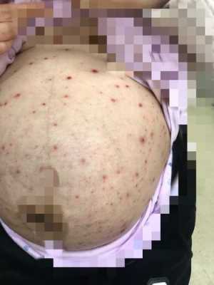 孕妇起水痘怎么办,孕妇得水痘影响胎儿吗知乎  第1张