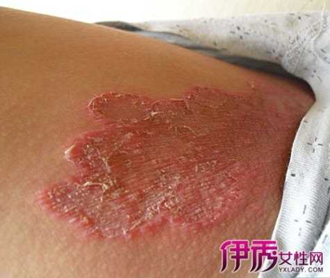 腹股沟痒是怎么回事呢,孕期腹股沟痒是怎么回事 第1张 腹股沟痒是怎么回事呢,孕期腹股沟痒是怎么回事 第1张