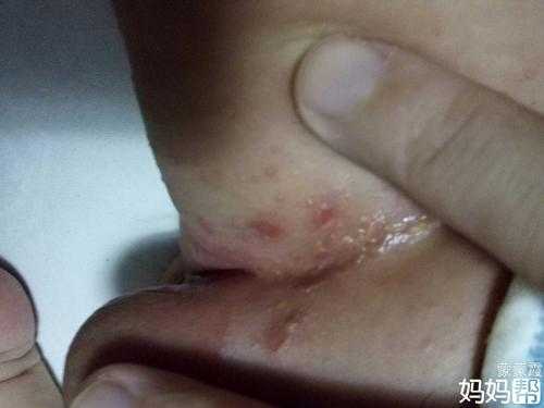 腹股沟痒是怎么回事呢,孕期腹股沟痒是怎么回事 第3张 腹股沟痒是怎么回事呢,孕期腹股沟痒是怎么回事 第3张