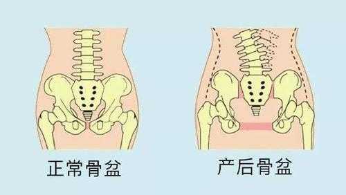 剖腹产需要做盆骨修复吗,孕期骨盆变化图片 第2张 剖腹产需要做盆骨修复吗,孕期骨盆变化图片 第2张