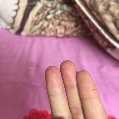 孕期手上脱皮(孕期手上脱皮是怎么回事) 第2张 孕期手上脱皮(孕期手上脱皮是怎么回事) 第2张