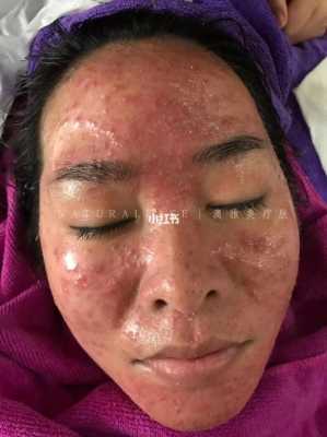 孕期激素脸（孕期激素脸爆发怎么处理）  第1张