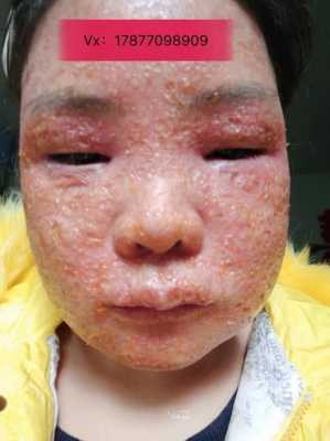 孕期激素脸（孕期激素脸爆发怎么处理）  第2张