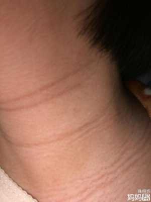 孕期脖颈纹(孕期脖颈纹生了孩子会下去吗) 第2张 孕期脖颈纹(孕期脖颈纹生了孩子会下去吗) 第2张