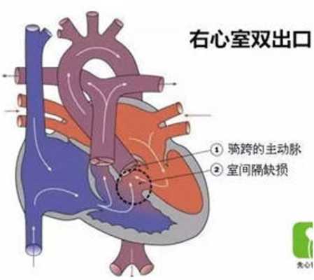 右心房的入口和出口,胎儿右室双出口怎么办  第2张