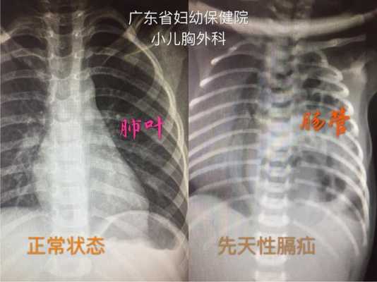 胎儿膈疝是遗传的吗(胎儿膈疝是遗传的吗) 第1张 胎儿膈疝是遗传的吗(胎儿膈疝是遗传的吗) 第1张