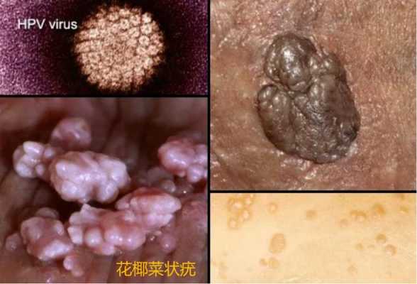 尖锐湿庞对胎儿的影响(我得了尖锐湿疣,可以要孩子吗) 第1张 尖锐湿庞对胎儿的影响(我得了尖锐湿疣,可以要孩子吗) 第1张
