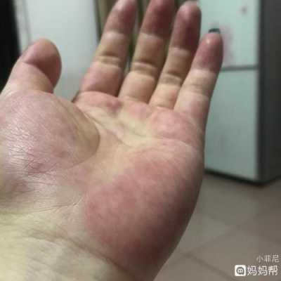 孕期手心痒(孕期手心痒怎么回事) 第2张 孕期手心痒(孕期手心痒怎么回事) 第2张