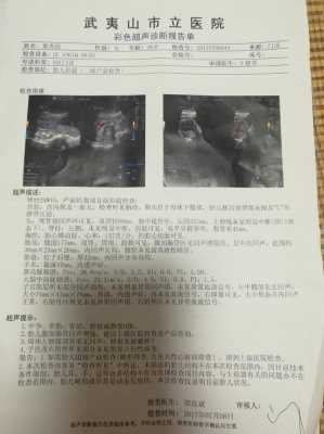 胎儿下腹部肠管回声增强(胎儿下腹部肠管回声增强怎么办) 第2张 胎儿下腹部肠管回声增强(胎儿下腹部肠管回声增强怎么办) 第2张