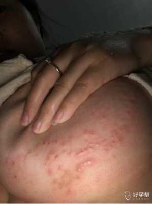 孕期胸前痒(孕期胸前痒) 第1张 孕期胸前痒(孕期胸前痒) 第1张
