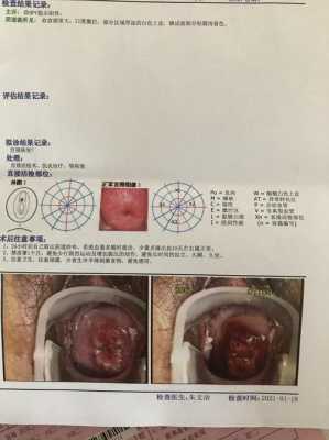 孕期宫颈活检(孕期宫颈活检有危险吗) 第1张 孕期宫颈活检(孕期宫颈活检有危险吗) 第1张