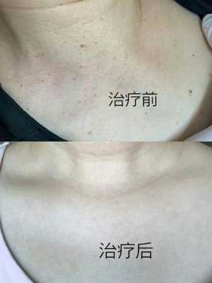 脖子长很多疣怎么办,孕期脖子长疣是什么原因造成的 第2张 脖子长很多疣怎么办,孕期脖子长疣是什么原因造成的 第2张