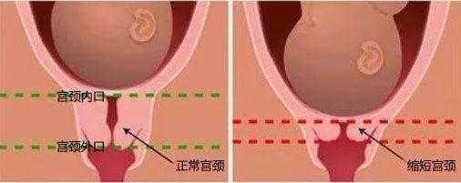孕14周多宫颈管长度27mm正常吗,孕期宫颈管长度多少正常范围 第1张 孕14周多宫颈管长度27mm正常吗,孕期宫颈管长度多少正常范围 第1张