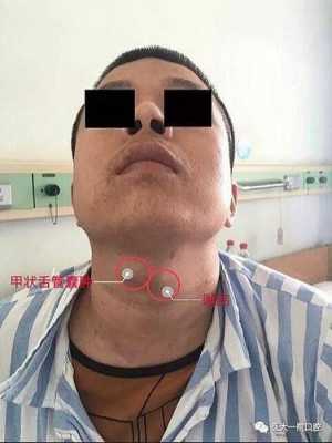 胎儿舌囊肿(那请问甲舌囊肿是怎么回事) 第2张 胎儿舌囊肿(那请问甲舌囊肿是怎么回事) 第2张