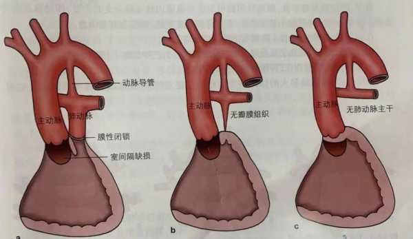 胎儿肺囊腺瘤怎么办,胎儿肺动脉异位 第1张 胎儿肺囊腺瘤怎么办,胎儿肺动脉异位 第1张
