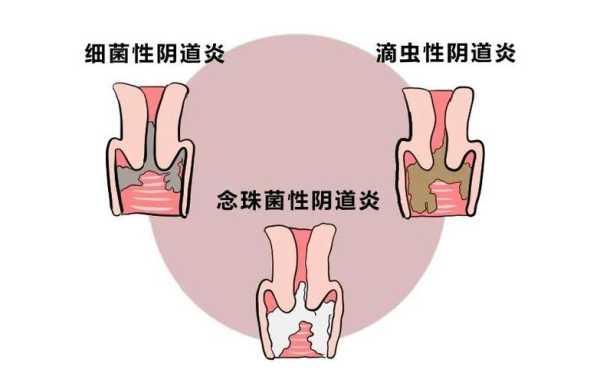 孕期阴道好痒(怀孕外阴痒怎么办) 第2张 孕期阴道好痒(怀孕外阴痒怎么办) 第2张