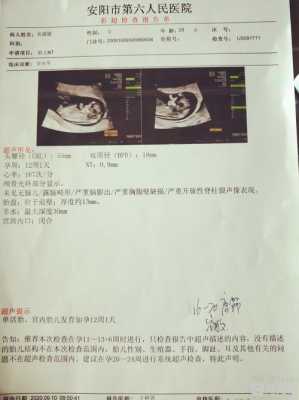 胎儿nt指(t和nt是啥意思) 第3张 胎儿nt指(t和nt是啥意思) 第3张