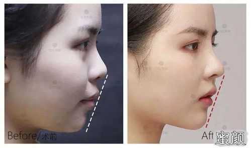 胎儿下颚短小(什么样的下巴属于短的) 第3张 胎儿下颚短小(什么样的下巴属于短的) 第3张