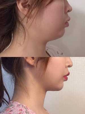 胎儿下颚短小(什么样的下巴属于短的) 第2张 胎儿下颚短小(什么样的下巴属于短的) 第2张