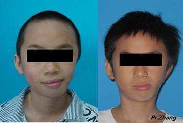胎儿下颚短小(什么样的下巴属于短的) 第1张 胎儿下颚短小(什么样的下巴属于短的) 第1张