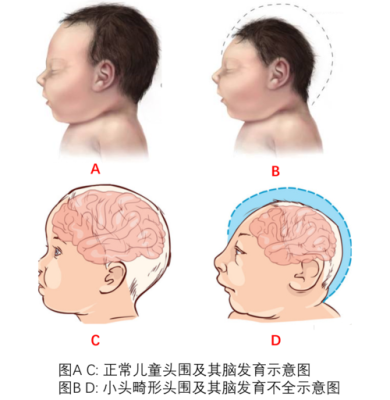 胎儿小脑畸形(胎儿小脑畸形) 第1张 胎儿小脑畸形(胎儿小脑畸形) 第1张