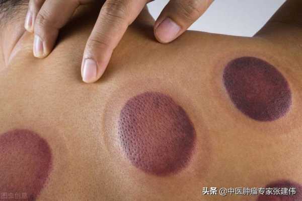 怀孕可以拔火罐吗,早孕期拔罐有影响吗  第2张