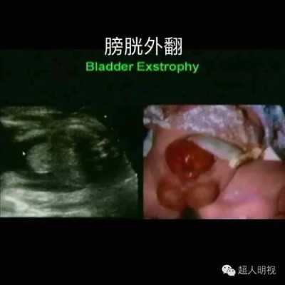 胎儿玩膀胱(胎儿膀胱未显示是怎么事) 第2张 胎儿玩膀胱(胎儿膀胱未显示是怎么事) 第2张
