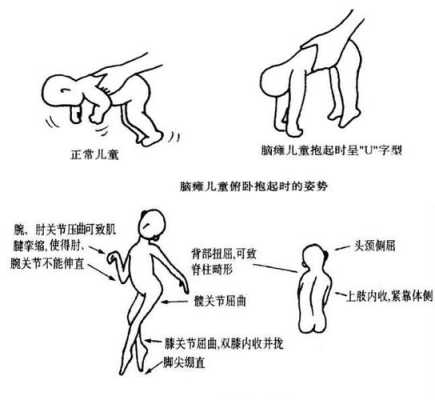 怀孕胎儿为什么会脑瘫,胎儿脑瘫原因有哪些 第3张 怀孕胎儿为什么会脑瘫,胎儿脑瘫原因有哪些 第3张