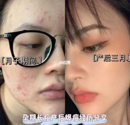 孕期长痘严重(孕期长痘严重怎么办) 第2张 孕期长痘严重(孕期长痘严重怎么办) 第2张