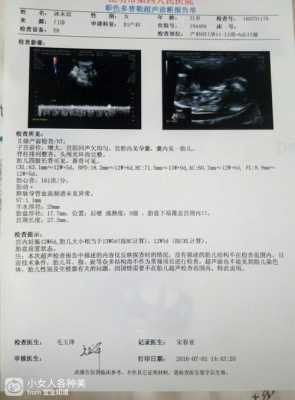 nt图片胎儿(NT结果怎么看) 第2张 nt图片胎儿(NT结果怎么看) 第2张