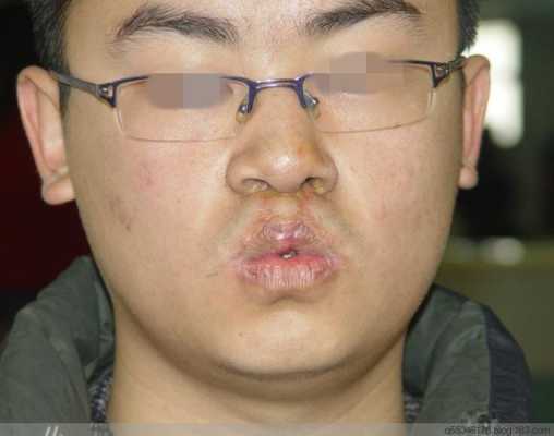 第一胎兔唇第二胎的几率是多少,胎儿兔唇几率大吗 第2张 第一胎兔唇第二胎的几率是多少,胎儿兔唇几率大吗 第2张