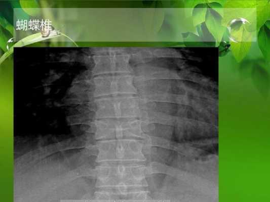蝴蝶锥是什么,胎儿蝴蝶锥原因  第3张