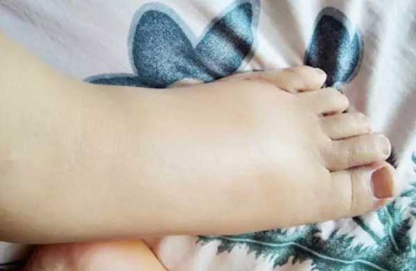 如何消除孕期水肿(怀孕为什么脚会肿,怀孕脚肿怎么办) 第2张 如何消除孕期水肿(怀孕为什么脚会肿,怀孕脚肿怎么办) 第2张
