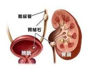 孕期肾结石症状(孕期肾结石症状表现) 第1张 孕期肾结石症状(孕期肾结石症状表现) 第1张
